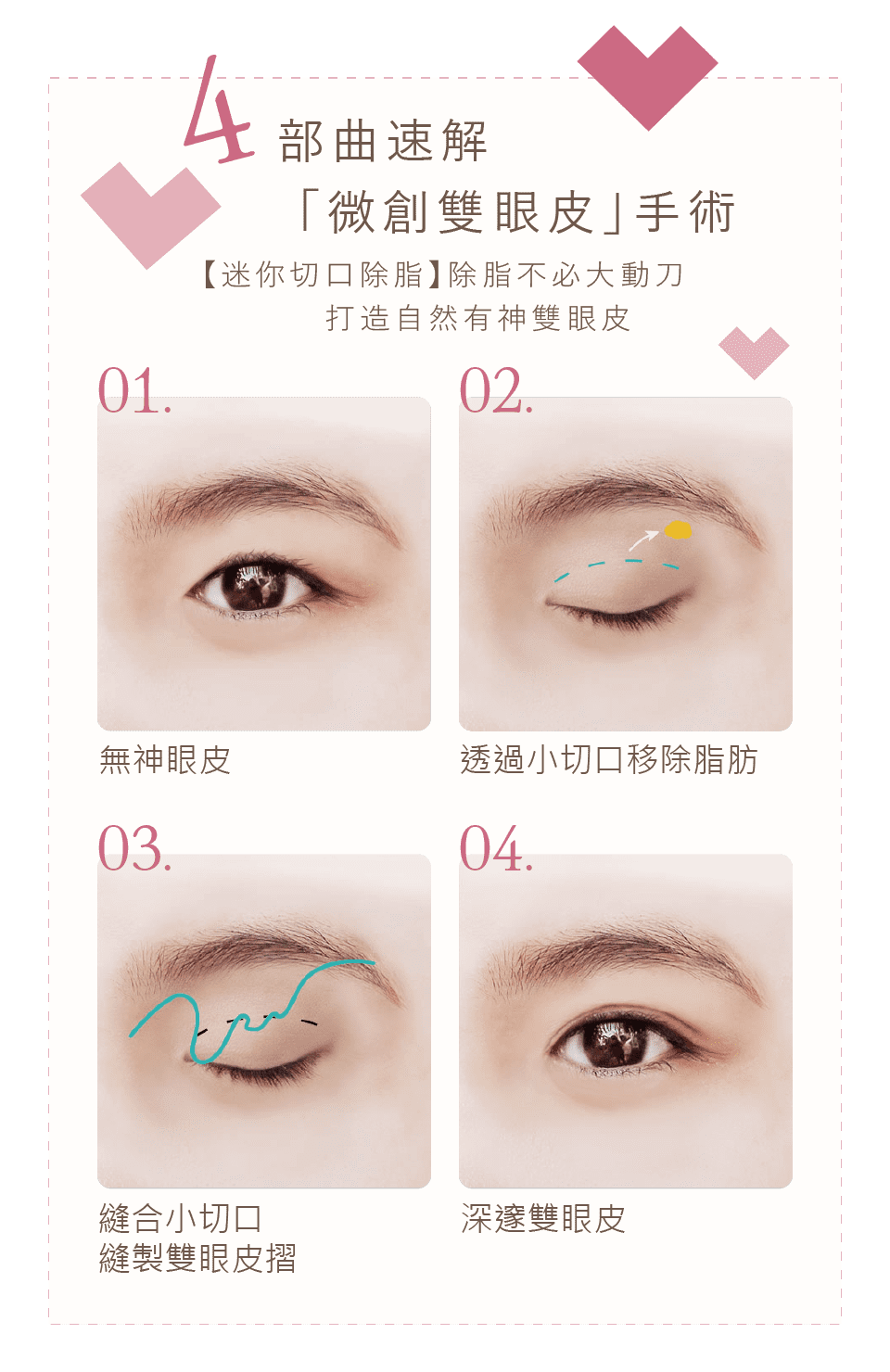 微創雙眼皮手術