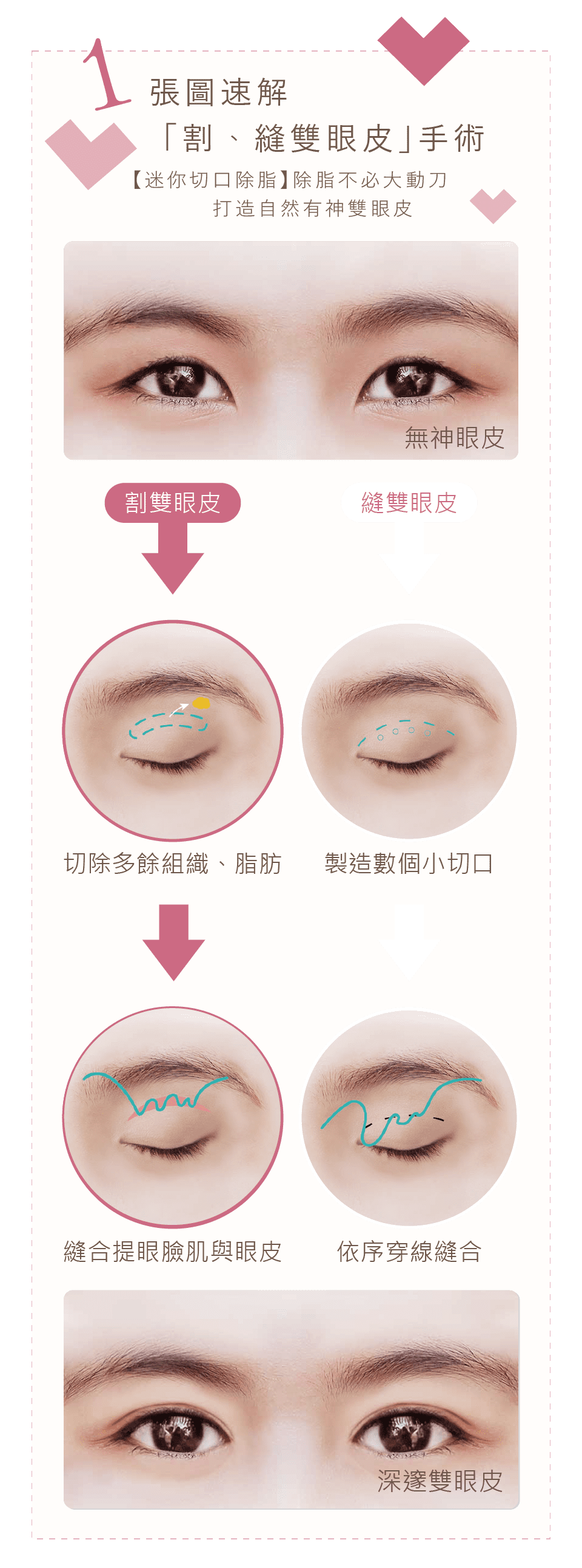 割縫雙眼皮
