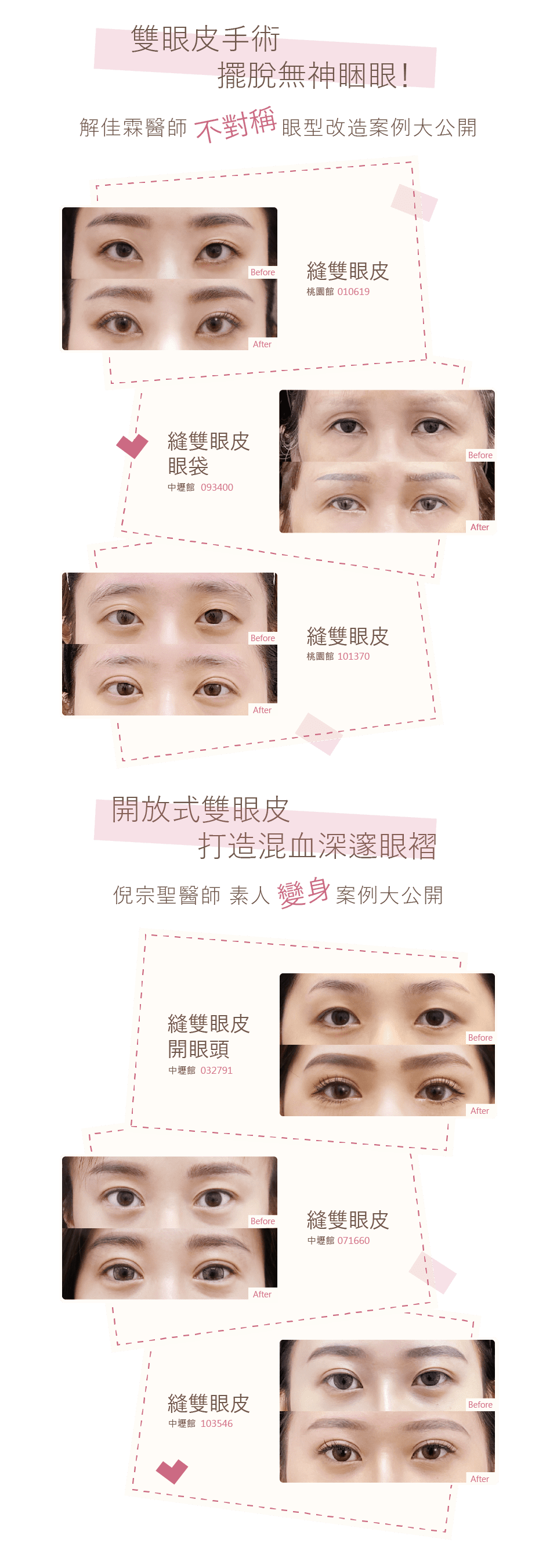 雙眼皮手術見證